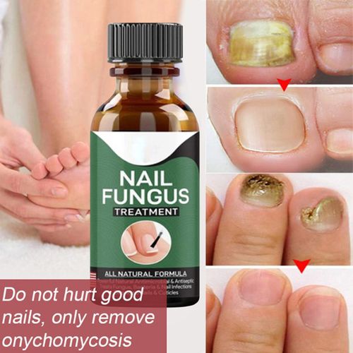 10ml Fast Nail Fungus Treatment Gel – Nail Repair Essence Serum for Onychomycosis & Paronychia – Effective Foot & Hand Nail Care Solution – Anti-Fungal Nail Repair for Cracked, Thick, Damaged & Discolored Toenails & Fingernails