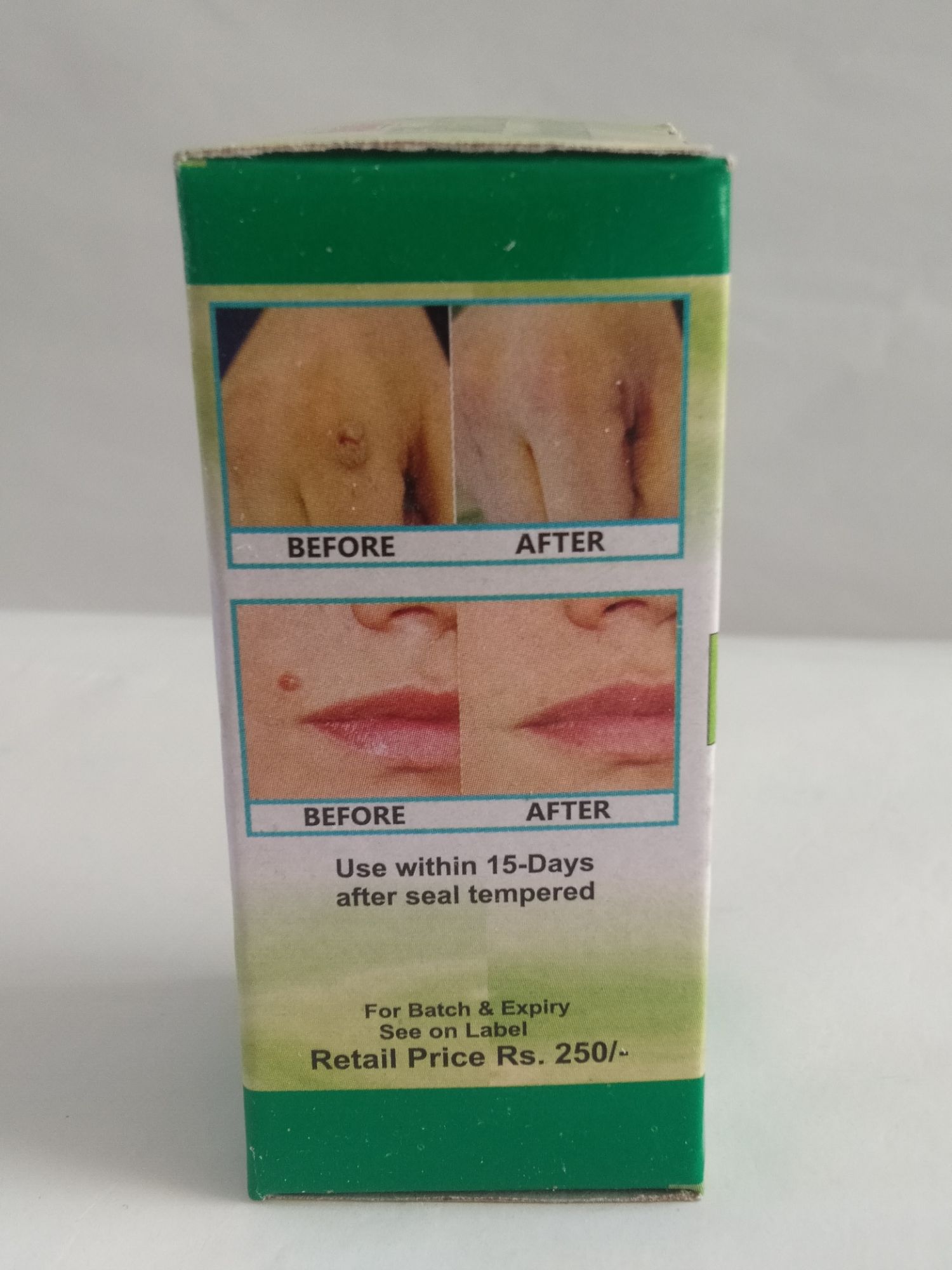 super warts Remover droper and cream