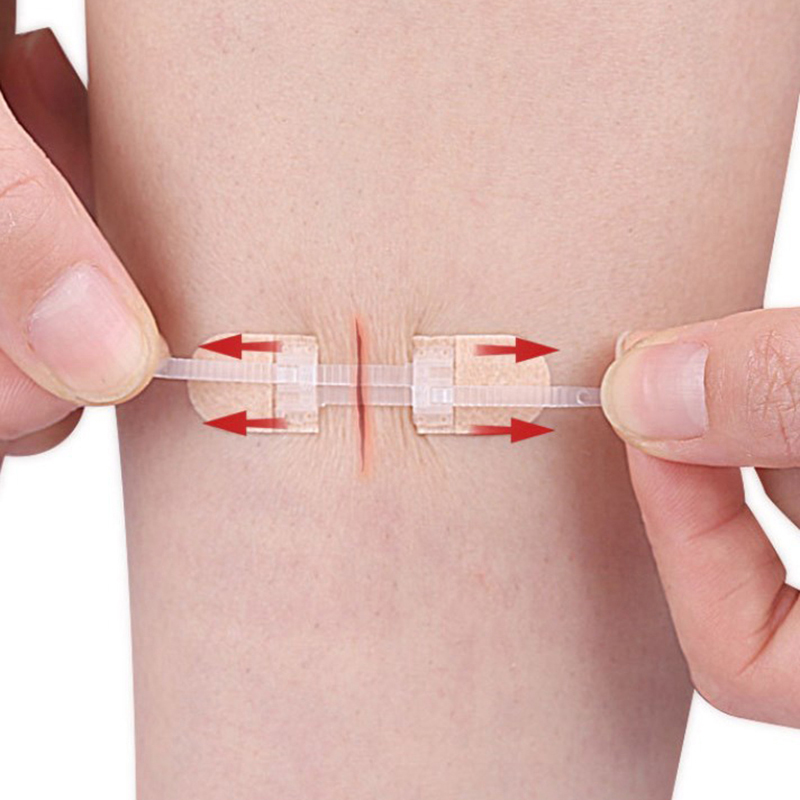 Elastic Seamless Zip Sutures Bandages, Zipper Strap Wound Closure Patches for Daily Wound Care