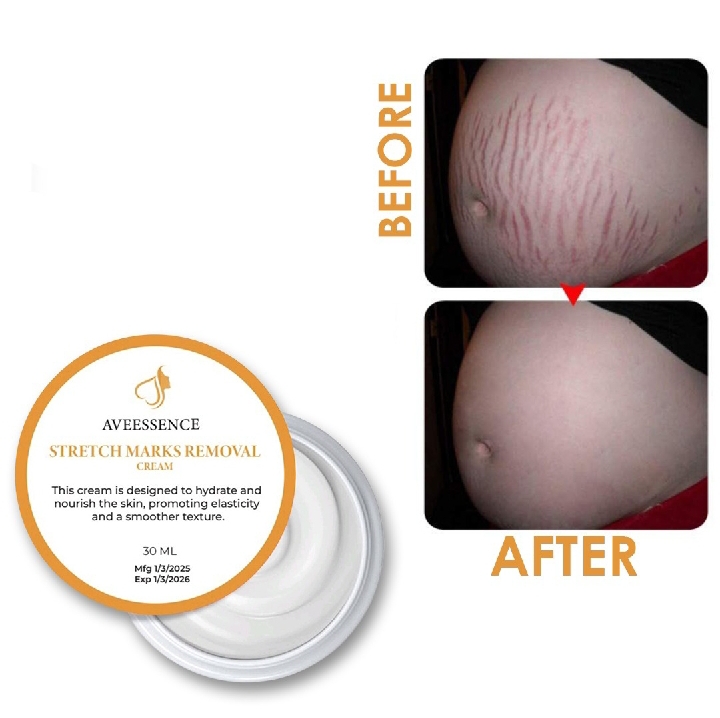 Pregnancy Stretch marks removal cream for Women, during after pregnancy ALL TYPE SKIN STRETCH (30 ml)